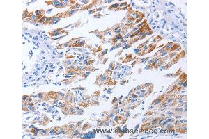 Immunohistochemistry of Human lung cancer using KIF3A Polyclonal Antibody at dilution of 1:40 (KIF3A anticorps)