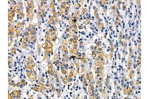 Occludin Mouse Monoclonal Antibody at 1/100 staining human gastric cancer and adjacent non-tumor tissue by IHC-P. (Occludin anticorps  (Internal Region))