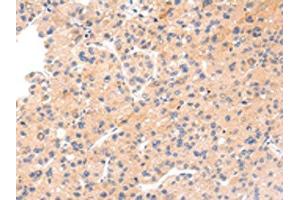 The image on the left is immunohistochemistry of paraffin-embedded Human liver cancer tissue using ABIN7191067(IKZF4 Antibody) at dilution 1/20, on the right is treated with synthetic peptide. (IKZF4 anticorps)