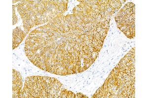 Immunohistochemistry (IHC) image for anti-Epithelial Cell Adhesion Molecule (EPCAM) (AA 24-265) antibody (ABIN7453970) (Recombinant EpCAM anticorps  (AA 24-265))