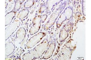 Formalin-fixed and paraffin embedded human gastric carcinoma tissue labeled with Anti-CENPA Polyclonal Antibody, Unconjugated at 1:200 followed by conjugation to the secondary antibody and DAB staining (CENPA anticorps  (AA 65-140))