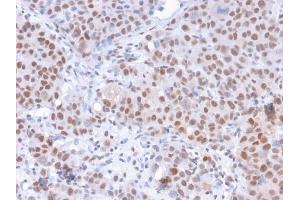 Formalin-fixed, paraffin-embedded human Colon Carcinoma stained with RNA Polymerase II / Poll II Mouse Monoclonal Antibody (8A7). (POLR2A/RPB1 anticorps  (pSer5))