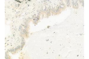 ABIN7093224, ABIN7097235 and ABIN7097236 at 1/100 staining human lung adenocarcinoma by IHC-P.