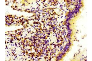 IHC image of ABIN7157886 diluted at 1:300 and staining in paraffin-embedded human lung cancer performed on a Leica BondTM system.