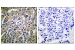 Immunohistochemical analysis of paraffin-embedded human breast carcinoma tissue using hCG beta antibody (ABIN5976419). (HCG beta anticorps  (C-Term))