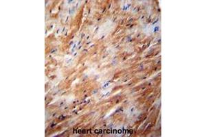 TFB2M Antibody (C-term) immunohistochemistry analysis in formalin fixed and paraffin embedded human heart carcinoma followed by peroxidase conjugation of the secondary antibody and DAB staining. (TFB2M anticorps  (C-Term))