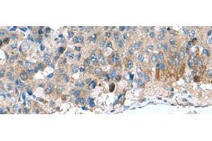 Immunohistochemistry of paraffin-embedded Human liver cancer tissue using HSD11B1 Polyclonal Antibody at dilution of 1:70(x200) (HSD11B1 anticorps)