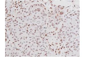 ABIN6267365 at 1/200 staining Human lung cancer tissue sections by IHC-P. (KIT anticorps  (pTyr721))