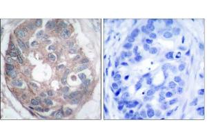 Immunohistochemical analysis of paraffin-embedded human breast carcinoma tissue, using Dab1 (Ab-232) antibody (E021251). (DAB1 anticorps)