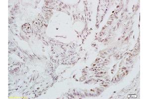 Formalin-fixed and paraffin embedded human colon carcinoma tissue labeled with Anti-LEF-1 Polyclonal Antibody, Unconjugated at 1:200 followed by conjugation to the secondary antibody and DAB staining (LEF1 anticorps  (AA 331-399))