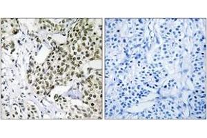 Immunohistochemistry analysis of paraffin-embedded human breast carcinoma tissue, using CAGE1 Antibody. (CAGE1 anticorps  (AA 711-760))