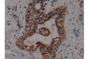 Detection of ERa in Human Breast cancer Tissue using Polyclonal Antibody to Estrogen Receptor Alpha (ERa)