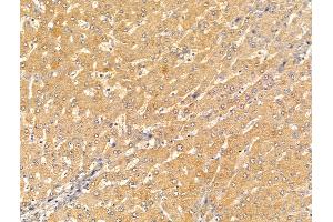 ABIN7094620 and ABIN7098670 at 1/100 staining Human liver cancer and adjacent normal tissues by IHC-P. (CRAT anticorps  (Internal Region))