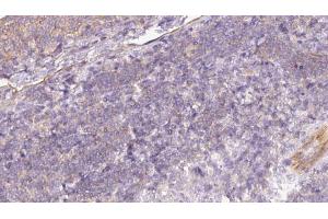 ABIN6273057 at 1/100 staining Human lymph cancer tissue by IHC-P.
