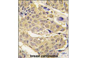 Formalin-fixed and paraffin-embedded human breast carcinoma tissue reacted with EPRS polyclonal antibody  , which was peroxidase-conjugated to the secondary antibody, followed by DAB staining. (EPRS anticorps  (N-Term))