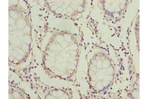Immunohistochemistry of paraffin-embedded human colon cancer using ABIN7165635 at dilution of 1:100 (HOOK1 anticorps  (AA 301-600))