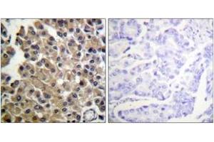 Immunohistochemistry analysis of paraffin-embedded human breast carcinoma tissue, using PDGFRB (Ab-1009) Antibody. (PDGFRB anticorps  (AA 981-1030))