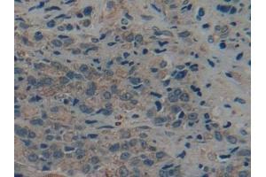 Detection of CK9 in Human Prostate cancer Tissue using Polyclonal Antibody to Cytokeratin 9 (CK9)