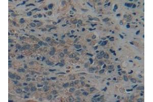 Detection of CK9 in Human Prostate cancer Tissue using Polyclonal Antibody to Cytokeratin 9 (CK9) (KRT9 anticorps  (AA 315-456))