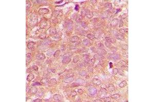 Immunohistochemical analysis of NBEAL1 staining in human breast cancer formalin fixed paraffin embedded tissue section. (NBEAL1 anticorps)
