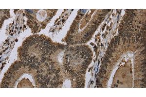 Immunohistochemistry of paraffin-embedded Human colon cancer using HIST1H2AH Polyclonal Antibody at dilution of 1:40