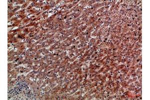Immunohistochemical analysis of paraffin-embedded Human-liver-cancer, antibody was diluted at 1:100