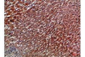 Immunohistochemical analysis of paraffin-embedded Human-liver-cancer, antibody was diluted at 1:100 (CXCR1 anticorps  (AA 1-50))