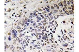 Immunohistochemistry analyzes of NF-H antibody in paraffin-embedded human lung carcinoma tissue. (NEFH anticorps)