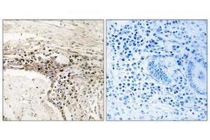 Immunohistochemistry analysis of paraffin-embedded human lung carcinoma tissue using SSH3 antibody.