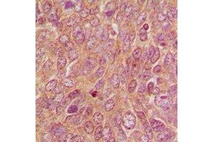 Immunohistochemical analysis of DUSP9 staining in human breast cancer formalin fixed paraffin embedded tissue section.