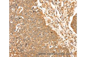 Immunohistochemistry of Human lung cancer using MAPK7 Polyclonal Antibody at dilution of 1:35 (MAPK7 anticorps)