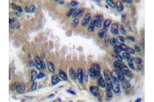 Immunohistochemical analysis of paraffin-embedded human lung cancer tissue using APAF1 polyclonal antibody . (APAF1 anticorps)