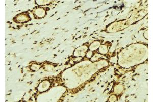 ABIN6274369 at 1/100 staining Human breast cancer tissue by IHC-P. (Translin anticorps  (Internal Region))