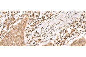 Immunohistochemistry of paraffin-embedded Human esophagus cancer tissue using KDM2A Polyclonal Antibody at dilution of 1:55(x200) (KDM2A anticorps)
