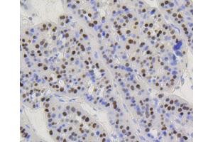 Paraformaldehyde-fixed, paraffin embedded Human liver carcinoma, Antigen retrieval by boiling in sodium citrate buffer (pH6) for 15min, Block endogenous peroxidase by 3% hydrogen peroxide for 30 minutes, Blocking buffer at 37°C for 20min, Antibody incubation with Cyclin D1 (2H4) Monoclonal Antibody  at 1:50 overnight at 4°C, followed by a conjugated secondary and DAB staining.