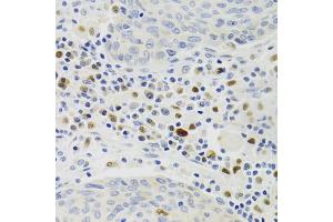 Immunohistochemistry of paraffin-embedded human lung cancer using GEMIN2 Antibody (ABIN1872798) at dilution of 1:100 (40x lens). (SIP1 anticorps)