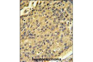CTSH Antibody IHC analysis in formalin fixed and paraffin embedded human hepatocarcinoma followed by peroxidase conjugation of the secondary antibody and DAB staining. (Cathepsin H anticorps  (N-Term))