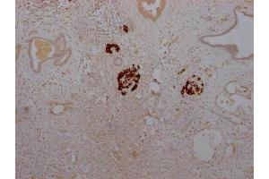 IHC image of ABIN7127574 diluted at 1:100 and staining in paraffin-embedded human pancreatic cancer performed on a Leica BondTM system.