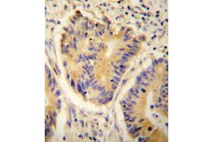 ADH4 antibody immunohistochemistry analysis in formalin fixed and paraffin embedded human colon carcinoma followed by peroxidase conjugation of the secondary antibody and DAB staining. (ADH4 anticorps  (C-Term))