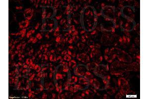 Formalin-fixed and paraffin embedded human gastric adenocarcinoma labeled with Rabbit Anti-GPR30 Polyclonal Antibody (ABIN685717) at 1:300 followed by conjugation to the secondary antibody and DAB staining.