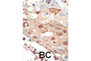 Formalin-fixed and paraffin-embedded human cancer tissue reacted with the primary antibody, which was peroxidase-conjugated to the secondary antibody, followed by AEC staining.
