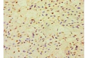 Immunohistochemistry of paraffin-embedded human breast cancer using ABIN7150999 at dilution of 1:100 (CBLC anticorps  (AA 245-474))