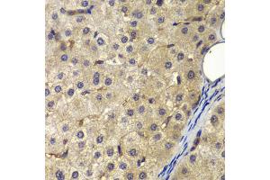Immunohistochemistry of paraffin-embedded human liver cancer using AP2A2 antibody (ABIN6292468) at dilution of 1:200 (40x lens). (AP2A2 anticorps)