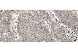 Immunohistochemistry of paraffin-embedded Human liver cancer tissue using UNC45B Polyclonal Antibody at dilution of 1:65(x200) (UNC45B anticorps)