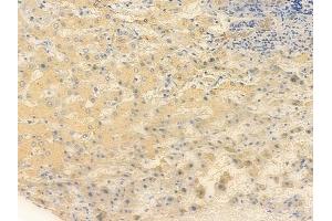 ABIN6256502 and ABIN6267435 at 1/100 staining human hepatocellular carcinoma by IHC-P. (SYT1/2 anticorps  (pThr202))