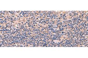 Immunohistochemistry of paraffin-embedded Human cervical cancer tissue using AHCYL1 Polyclonal Antibody at dilution of 1:70(x200) (AHCYL1 anticorps)