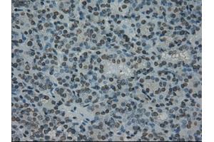 Immunohistochemical staining of paraffin-embedded Carcinoma of thyroid tissue using anti-PRKYmouse monoclonal antibody. (PRKY anticorps)