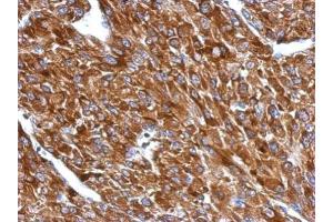 IHC-P Image Immunohistochemical analysis of paraffin-embedded U87 xenograft, using BIN1, antibody at 1:500 dilution.
