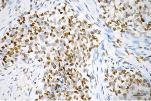 Immunohistochemistry was performed on paraffin-embedded human breast carcinoma using RBBP4 antibody (ABIN7800185), 1:200). (Recombinant Retinoblastoma Binding Protein 4 anticorps)
