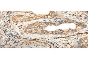Immunohistochemistry of paraffin-embedded Human cervical cancer tissue using ZNF8 Polyclonal Antibody at dilution of 1:40(x200) (ZNF8 anticorps)
